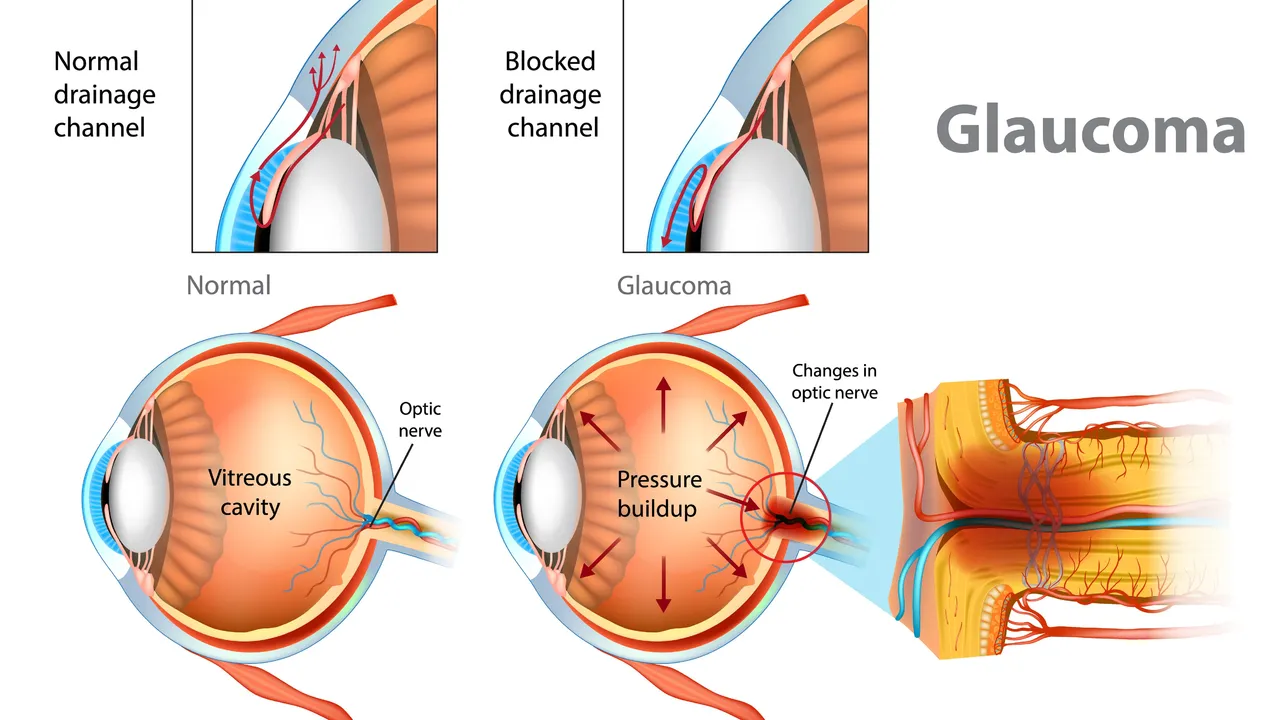 The effectiveness of dorzolamide in treating different types of glaucoma